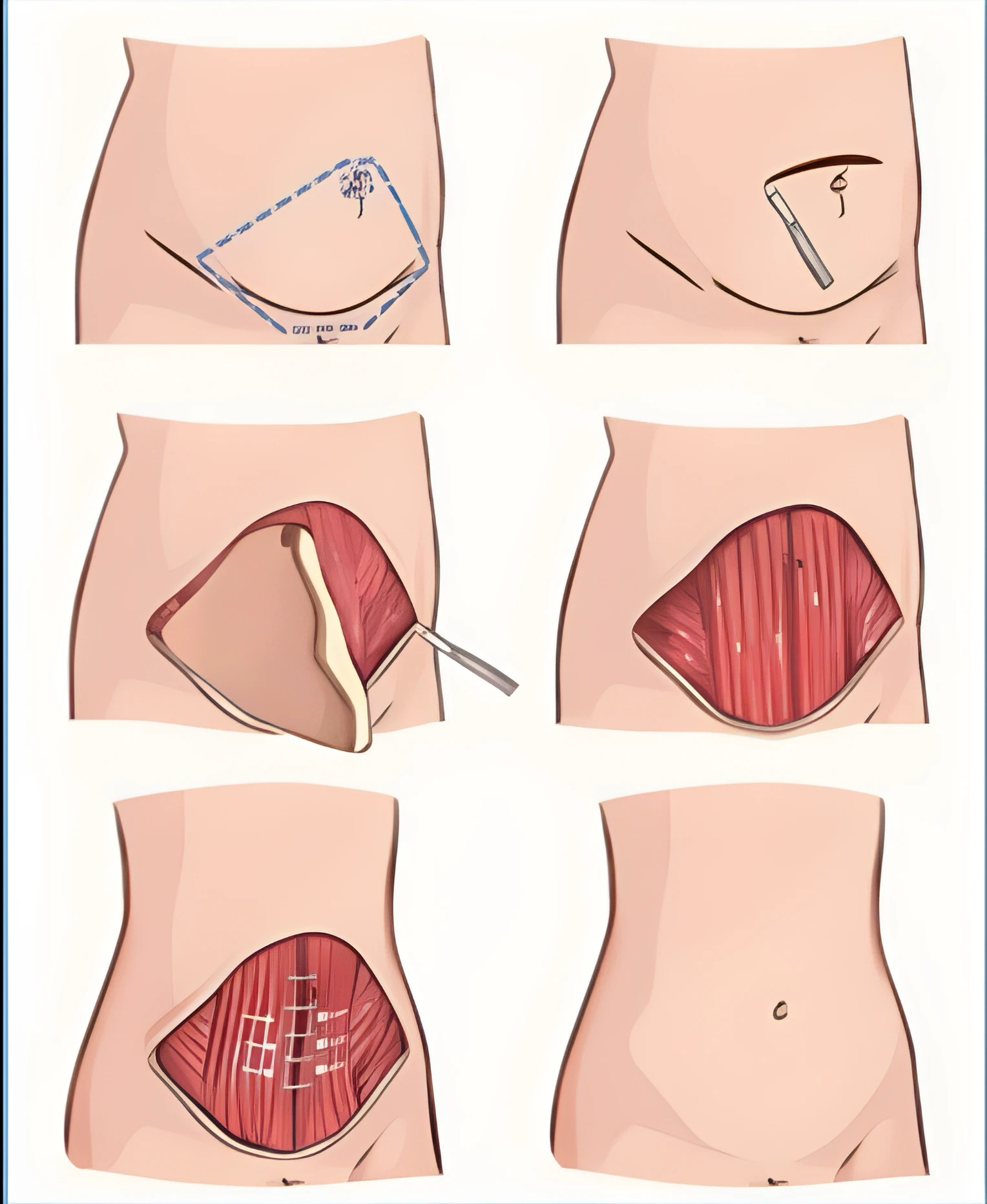 Tummy Tuck Procedure
